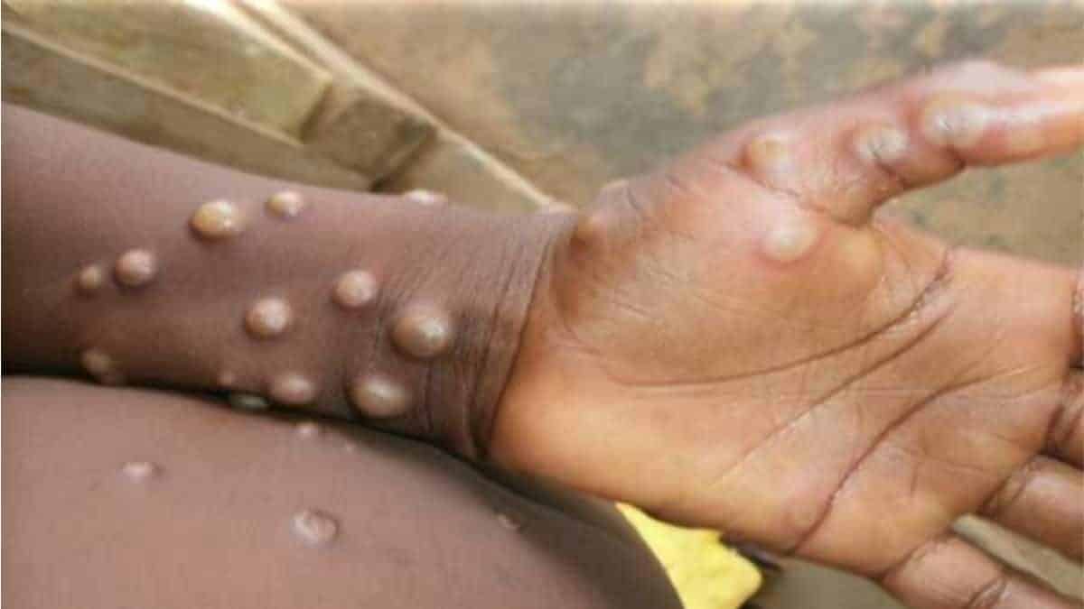 "Monkeypox": Public-health emergency announced in NY and new set of safety measures are being implemented
